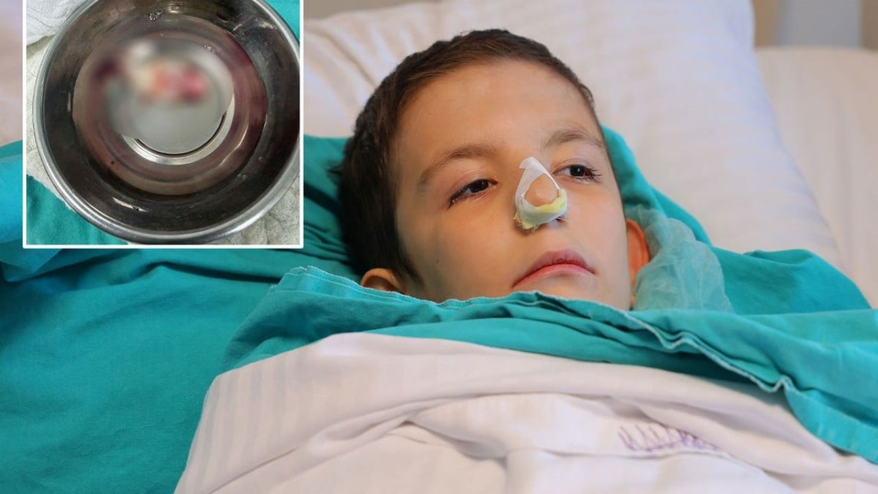 Burun tıkanıklığı diye gitti, doktorlar şoke oldu! Ağzından çekip aldılar