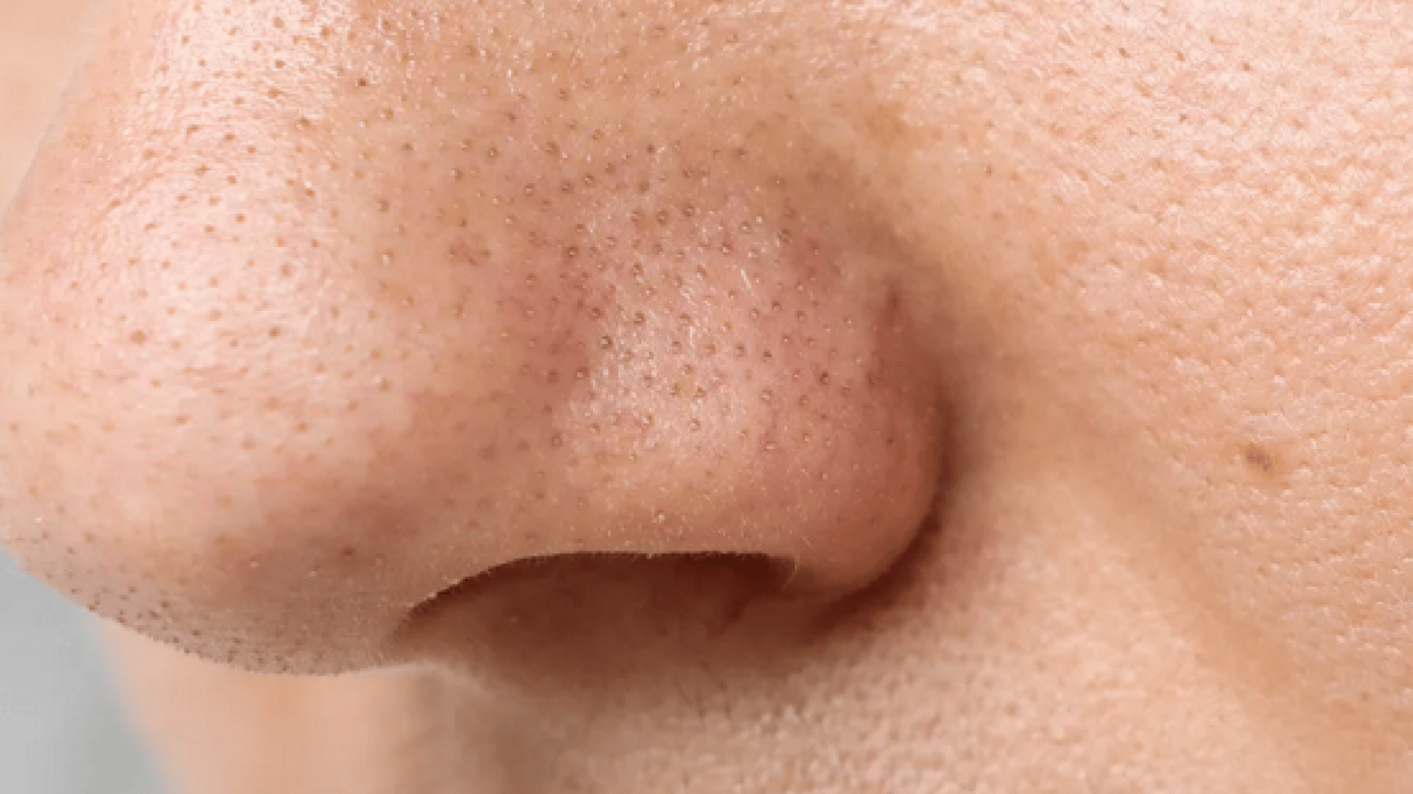 Foto - Burun tıkanıklığı kabusa dönüşmesin: İşte 4 pratik yöntemle kurtulabileceğiniz tüyolar…