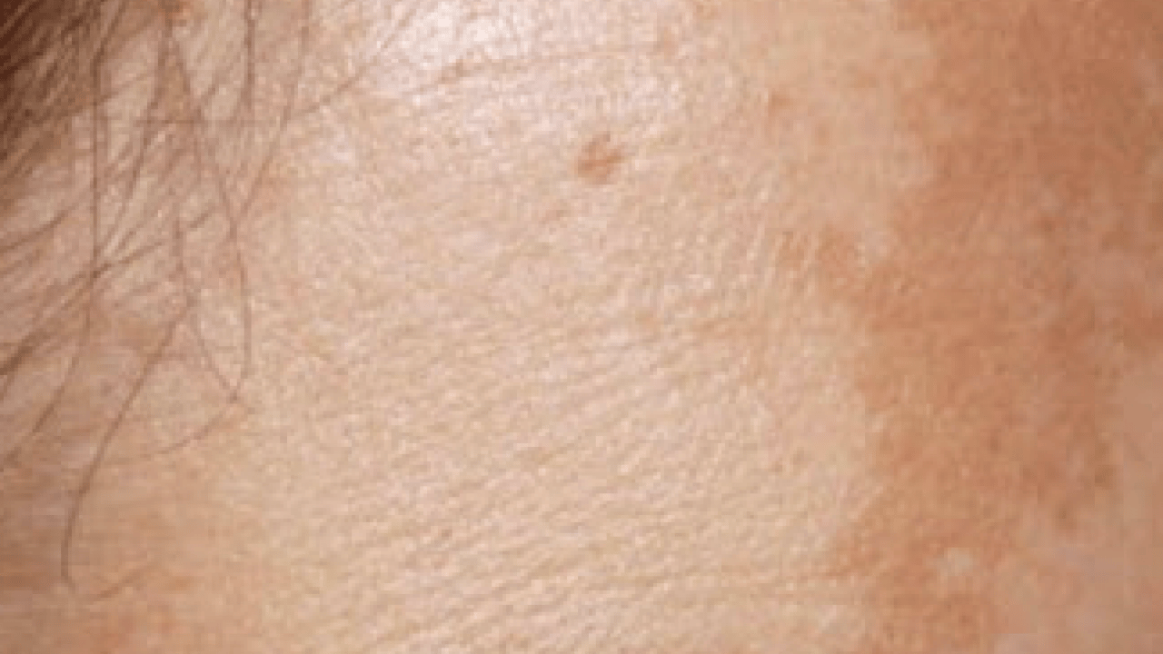 Foto - Büyük sıkıntı olabilir: Hangi mezoterapi yöntemleri peki! Güneş lekesi tedavisi her dönemde...