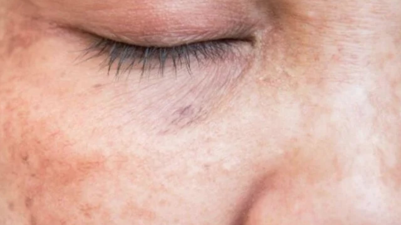 Foto - Büyük sıkıntı olabilir: Hangi mezoterapi yöntemleri peki! Güneş lekesi tedavisi her dönemde...