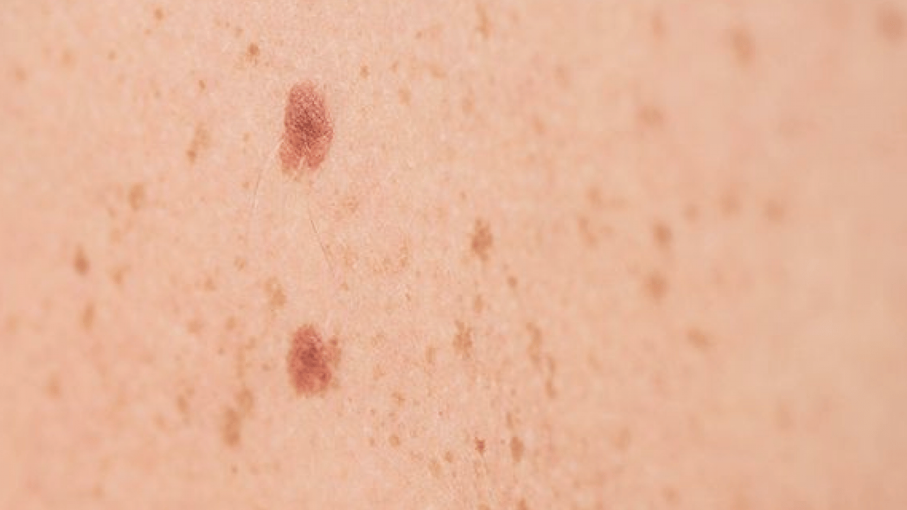 Foto - Büyük sıkıntı olabilir: Hangi mezoterapi yöntemleri peki! Güneş lekesi tedavisi her dönemde...