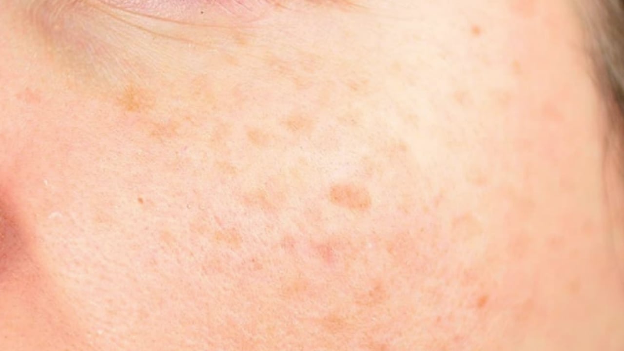 Foto - Büyük sıkıntı olabilir: Hangi mezoterapi yöntemleri peki! Güneş lekesi tedavisi her dönemde...