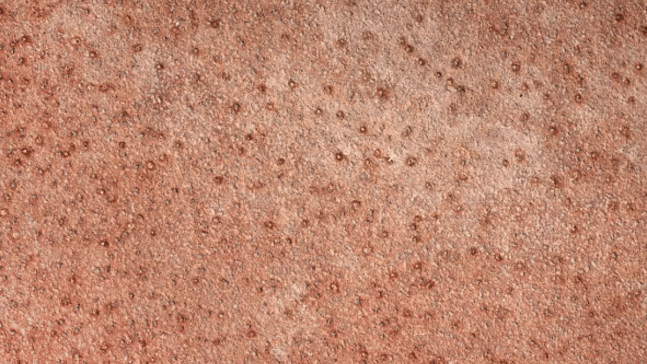 Foto - Büyük sıkıntı olabilir: Hangi mezoterapi yöntemleri peki! Güneş lekesi tedavisi her dönemde...