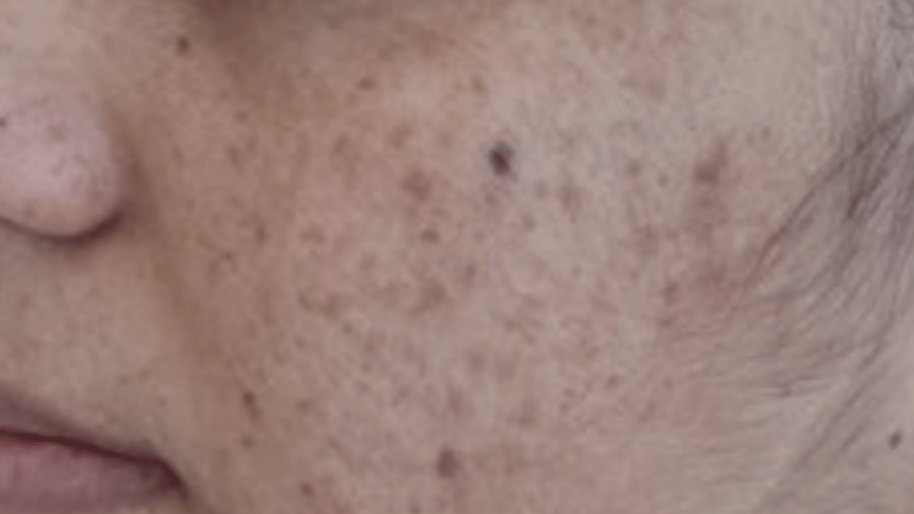 Foto - Büyük sıkıntı olabilir: Hangi mezoterapi yöntemleri peki! Güneş lekesi tedavisi her dönemde...