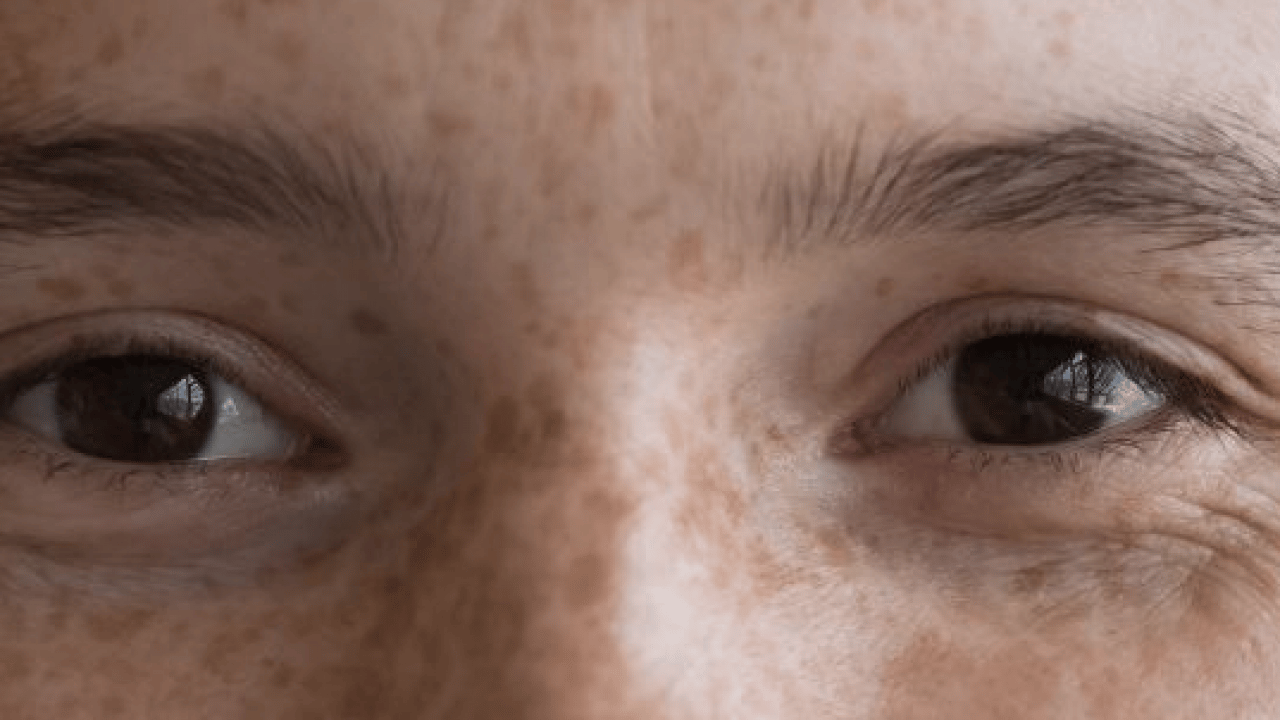 Foto - Büyük sıkıntı olabilir: Hangi mezoterapi yöntemleri peki! Güneş lekesi tedavisi her dönemde...