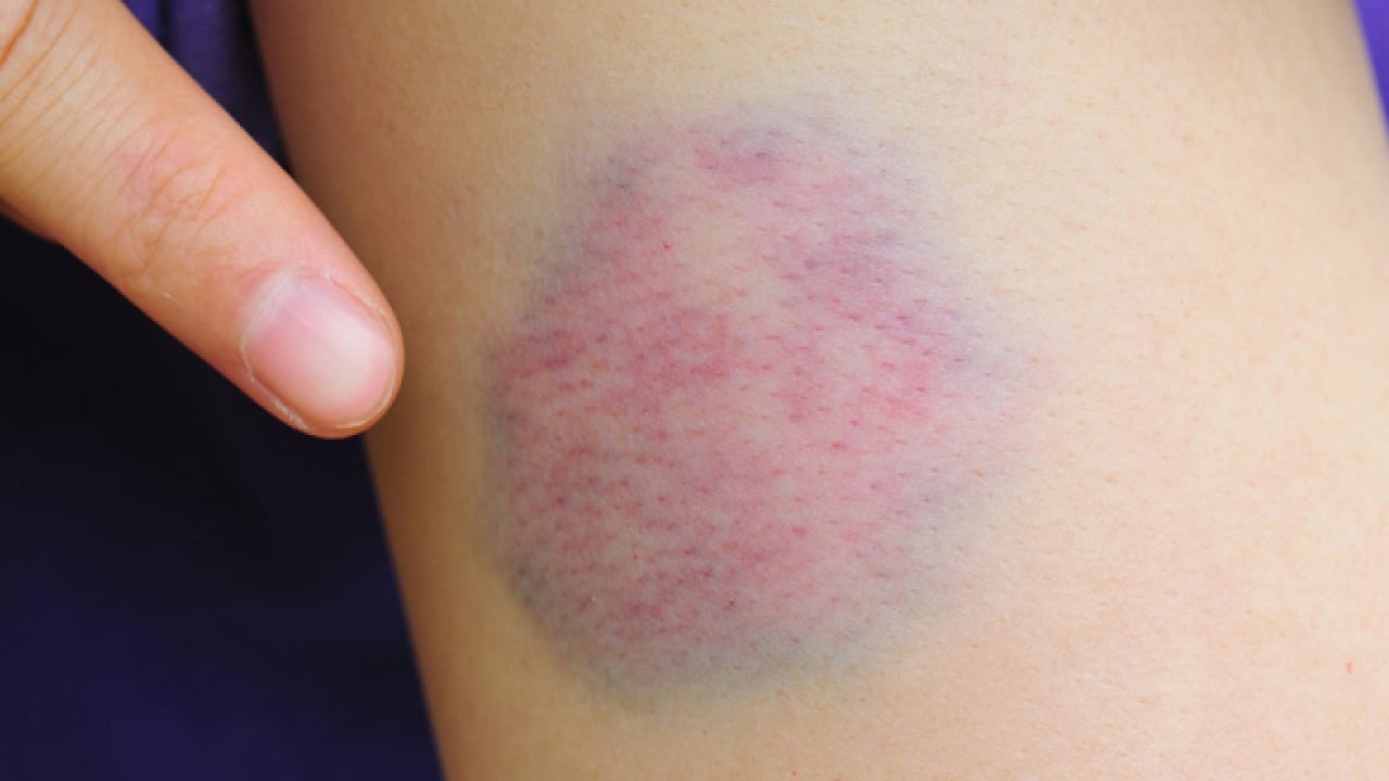 Foto - Vücudunuz kolayca morarıyor mu? Nedeni bu olabilir!