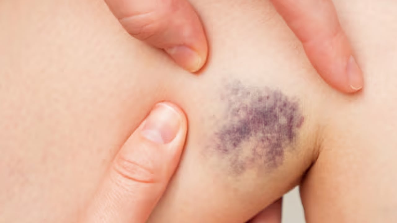 Foto - Vücudunuz kolayca morarıyor mu? Nedeni bu olabilir!