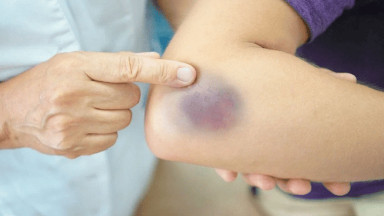 Vücudunuz kolayca morarıyor mu? Nedeni bu olabilir!