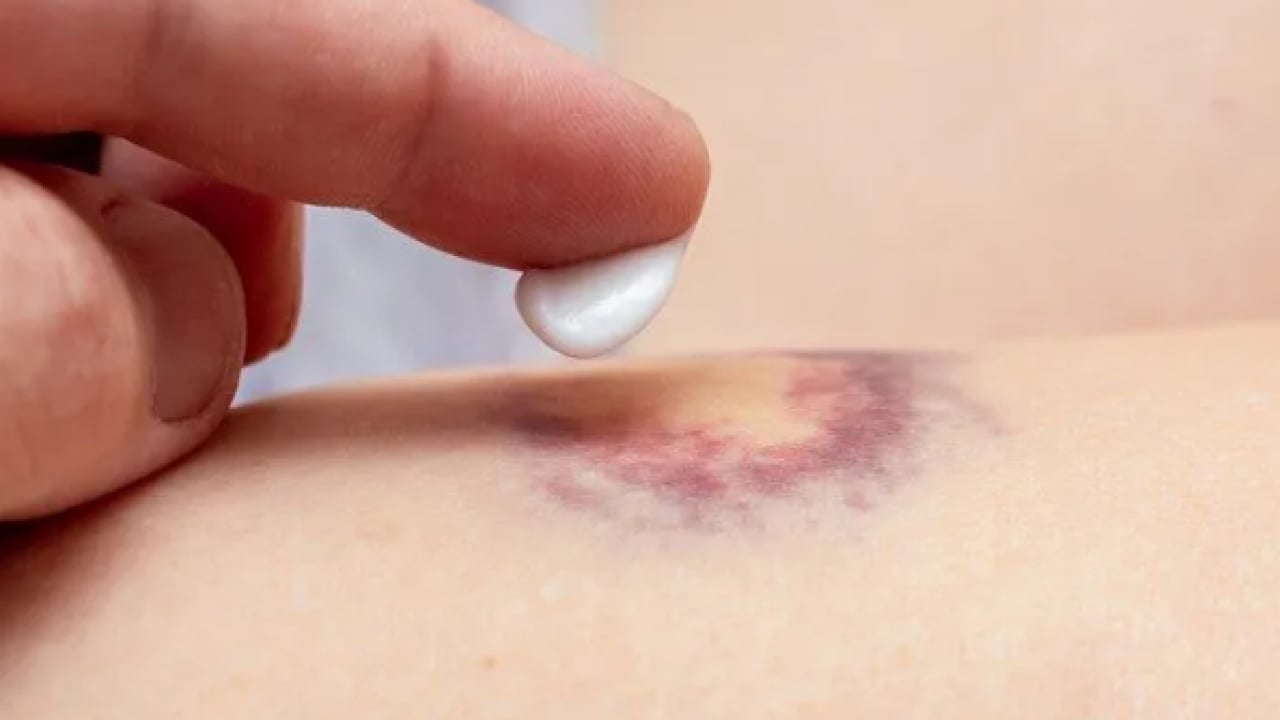 Foto - Vücudunuz kolayca morarıyor mu? Nedeni bu olabilir!