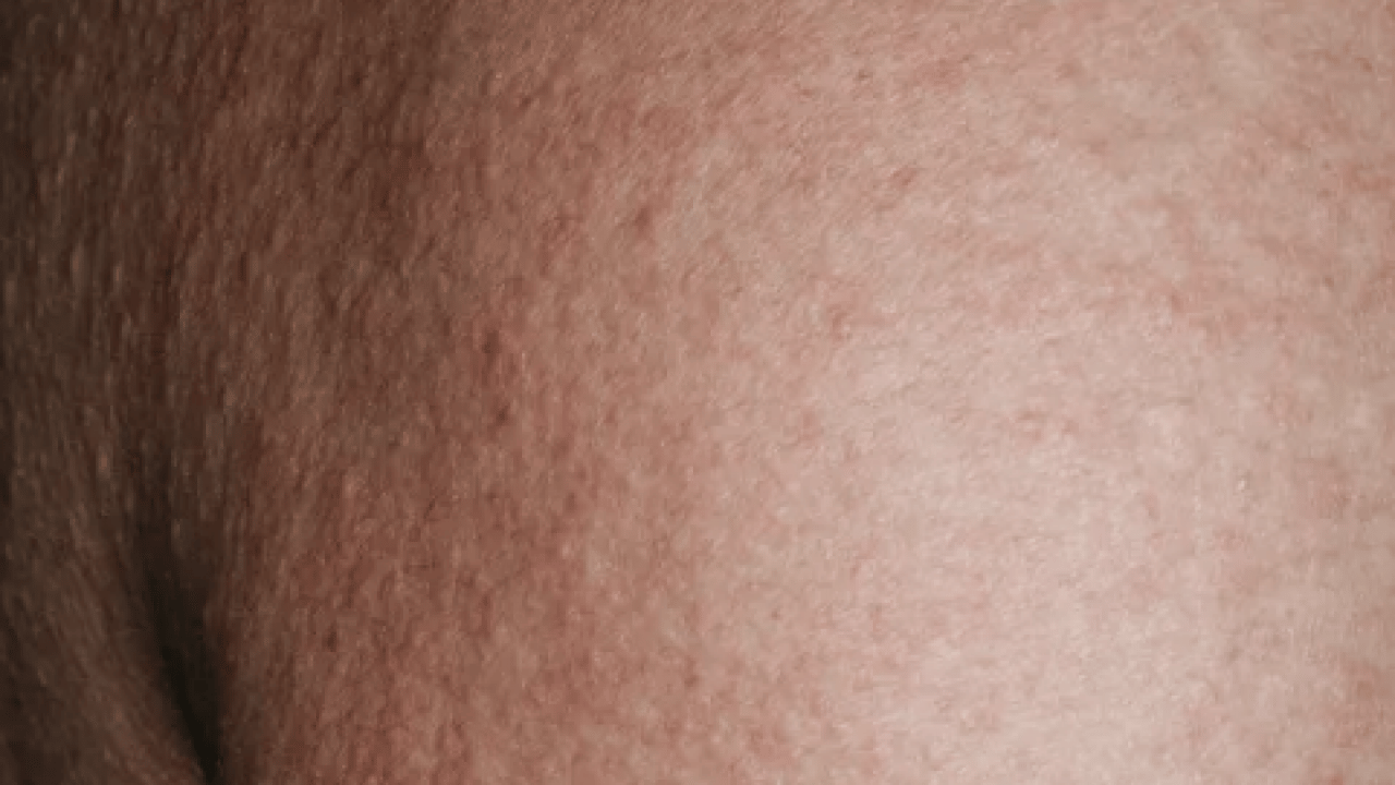 Foto - Cildinizdeki o pütürlerden kurtulun! Meğer 'tavuk derisi' görünümünün çözümü buymuş…