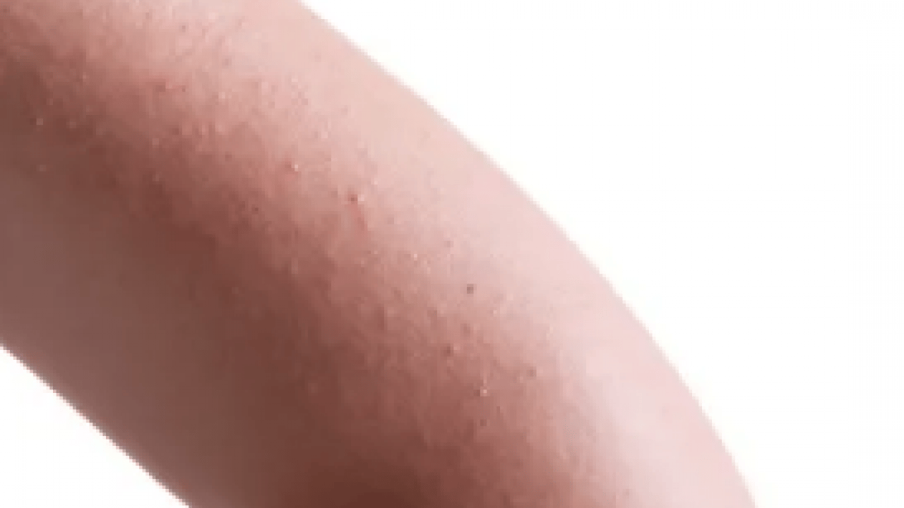 Foto - Cildinizdeki o pütürlerden kurtulun! Meğer 'tavuk derisi' görünümünün çözümü buymuş…