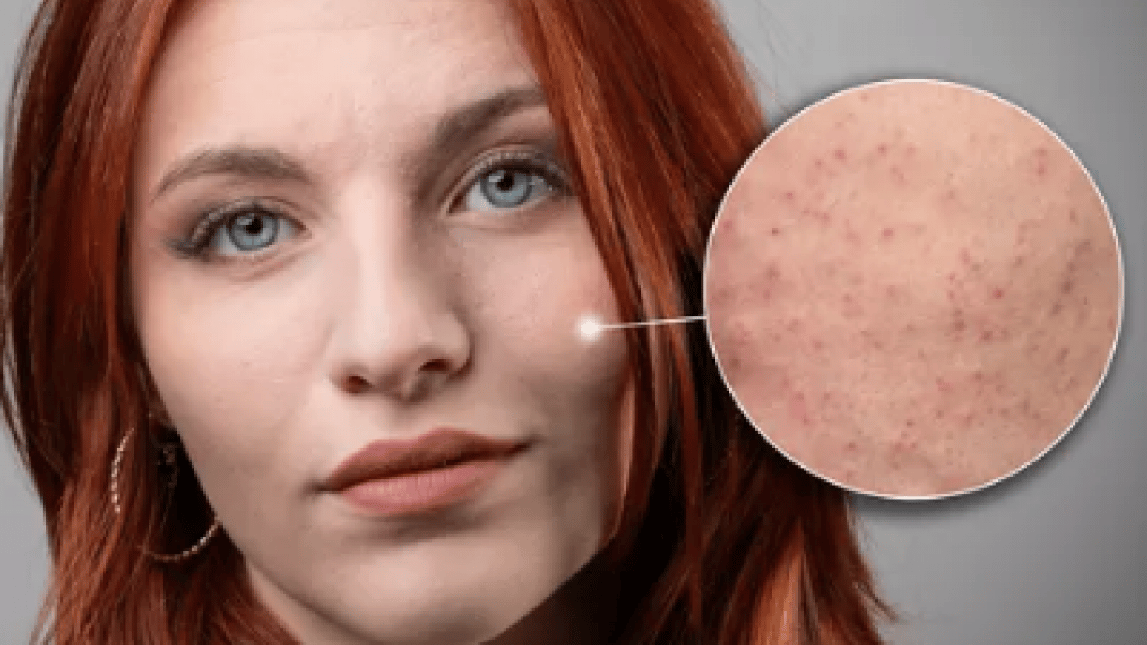 Foto - Cildinizdeki o pütürlerden kurtulun! Meğer 'tavuk derisi' görünümünün çözümü buymuş…