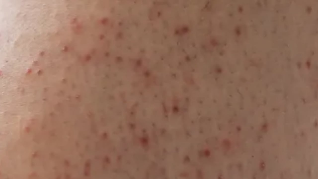 Cildinizdeki o pütürlerden kurtulun! Meğer 'tavuk derisi' görünümünün çözümü buymuş…