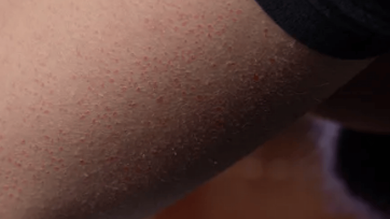 Foto - Cildinizdeki o pütürlerden kurtulun! Meğer 'tavuk derisi' görünümünün çözümü buymuş…