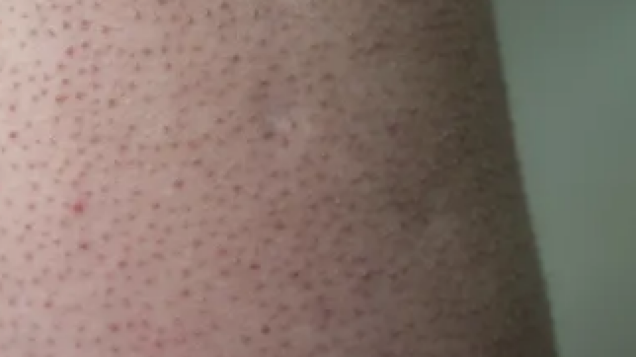 Foto - Cildinizdeki o pütürlerden kurtulun! Meğer 'tavuk derisi' görünümünün çözümü buymuş…