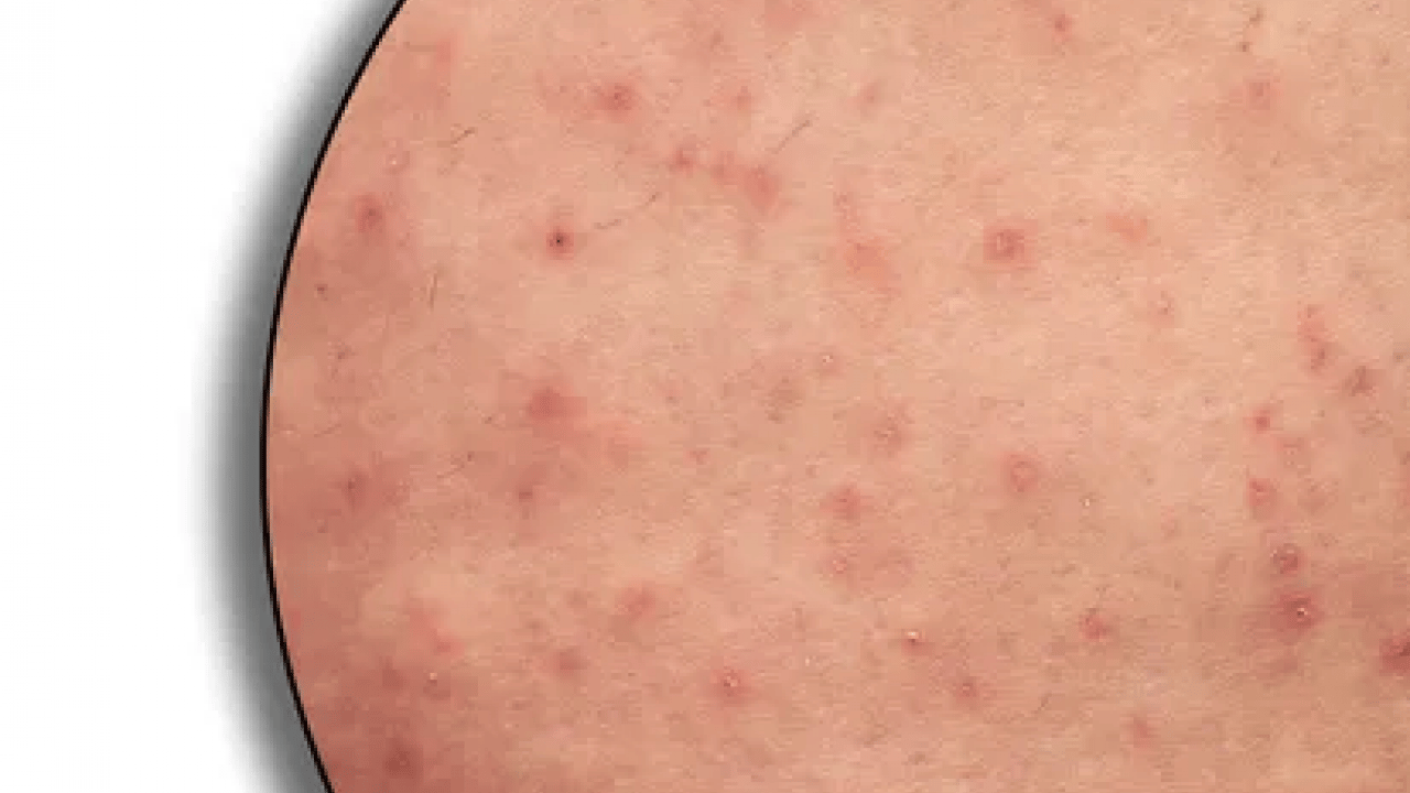 Foto - Cildinizdeki o pütürlerden kurtulun! Meğer 'tavuk derisi' görünümünün çözümü buymuş…