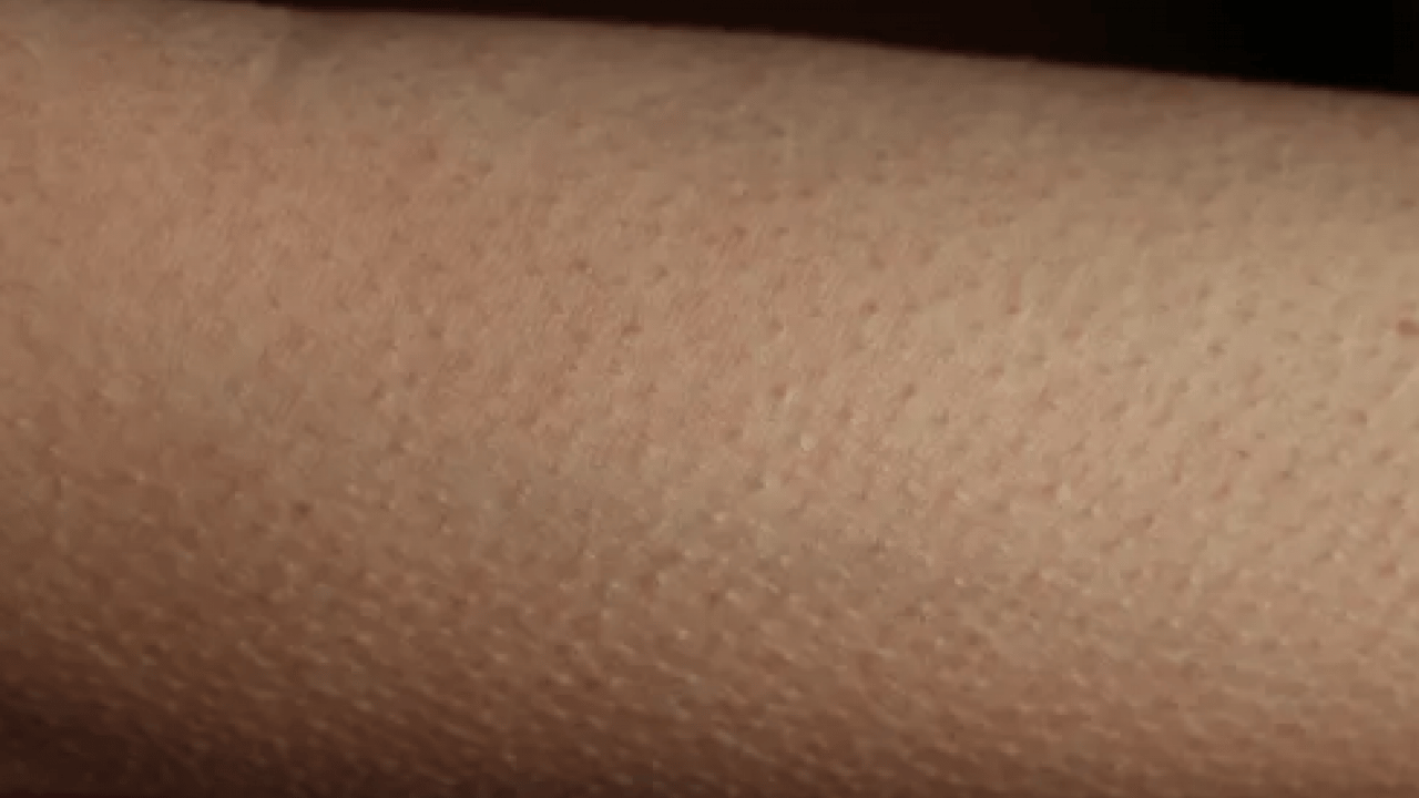 Foto - Cildinizdeki o pütürlerden kurtulun! Meğer 'tavuk derisi' görünümünün çözümü buymuş…