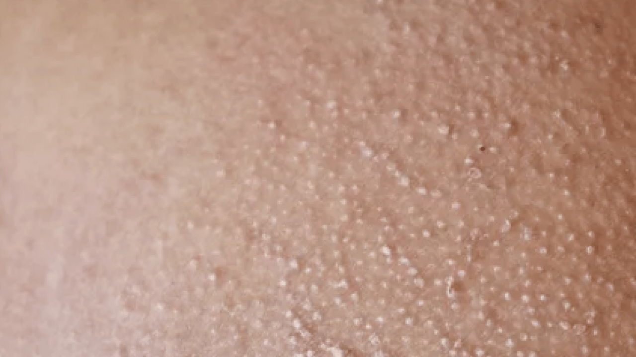 Foto - Cildinizdeki o pütürlerden kurtulun! Meğer 'tavuk derisi' görünümünün çözümü buymuş…