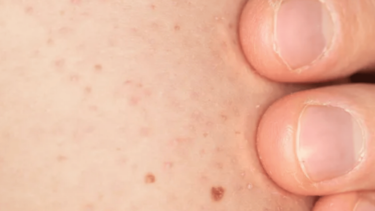 Foto - Cildinizdeki o pütürlerden kurtulun! Meğer 'tavuk derisi' görünümünün çözümü buymuş…