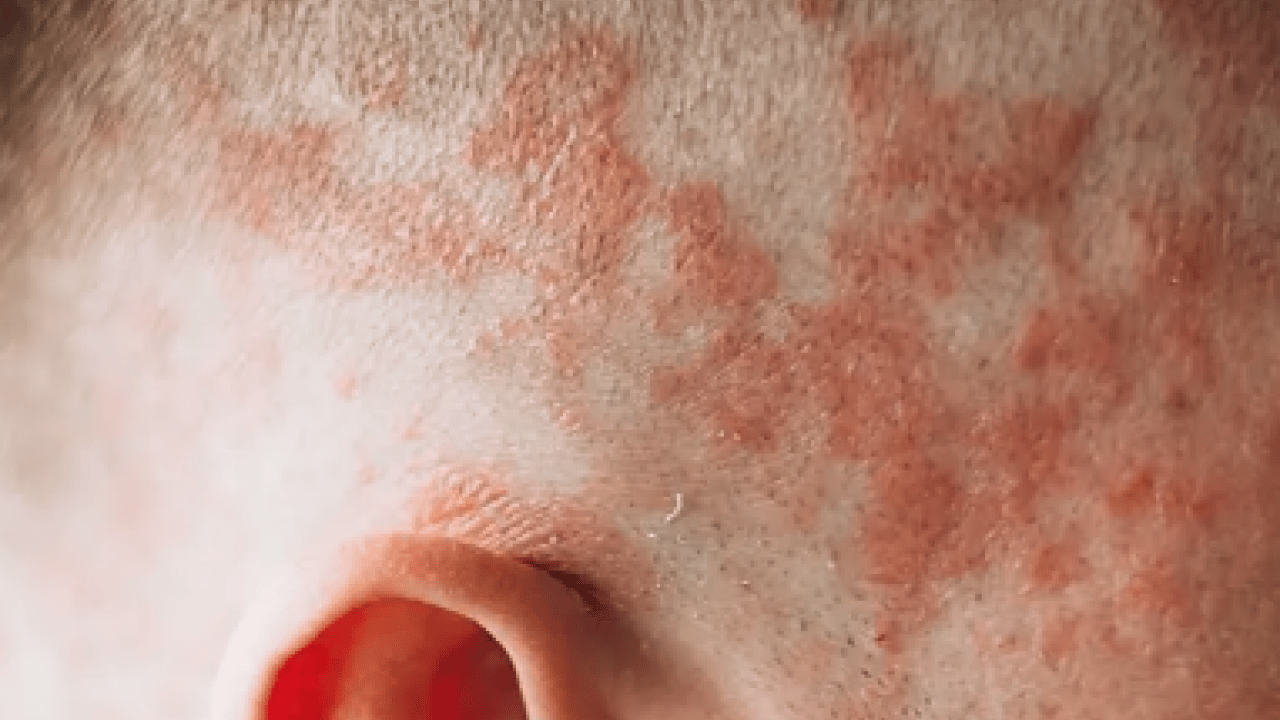 Foto - Cilt kuruyor! Kış aylarında egzama ile savaşmanın en etkili 7 yolu...