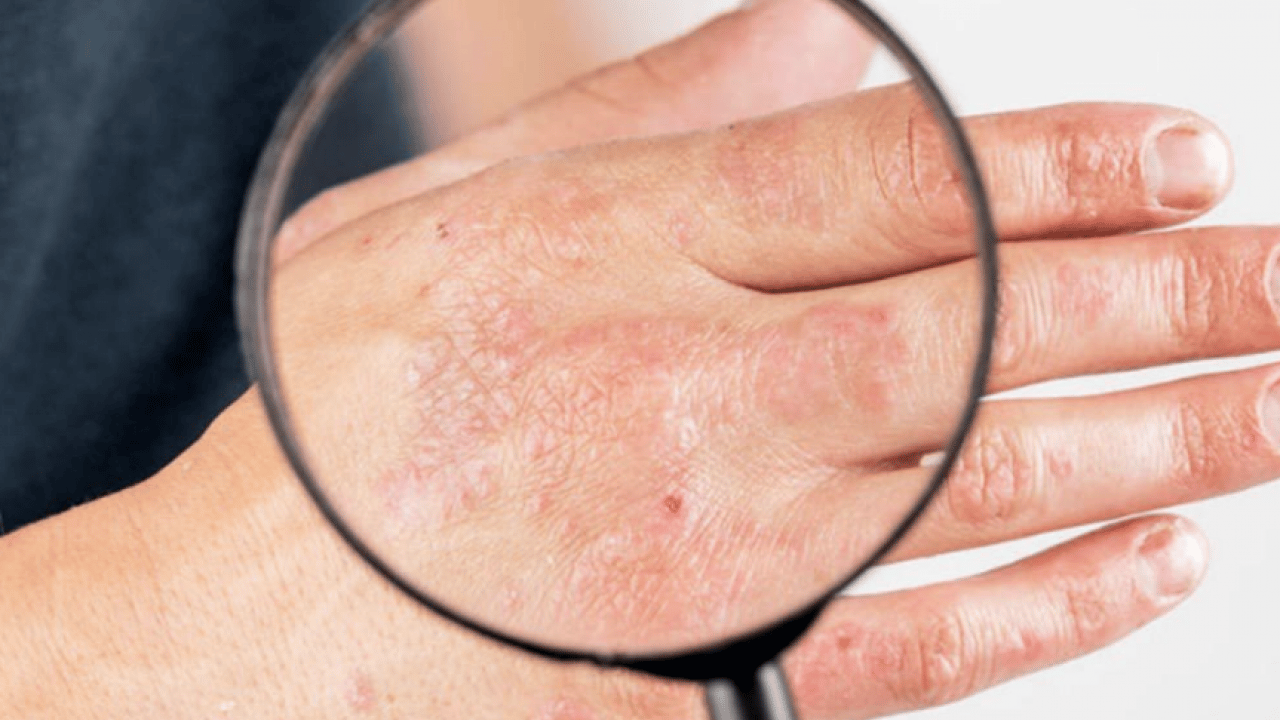 Foto - Cilt kuruyor! Kış aylarında egzama ile savaşmanın en etkili 7 yolu...