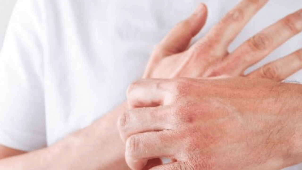 Foto - Cilt kuruyor! Kış aylarında egzama ile savaşmanın en etkili 7 yolu...