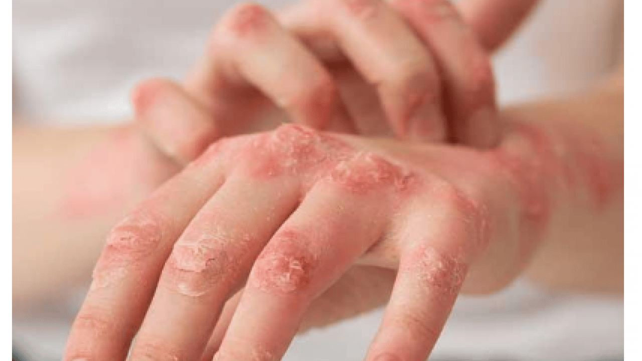 Foto - Cilt kuruyor! Kış aylarında egzama ile savaşmanın en etkili 7 yolu...