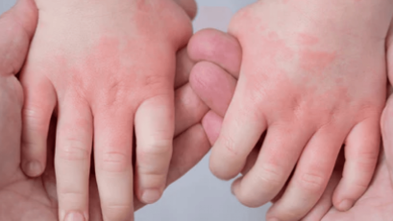 Foto - Cilt kuruyor! Kış aylarında egzama ile savaşmanın en etkili 7 yolu...