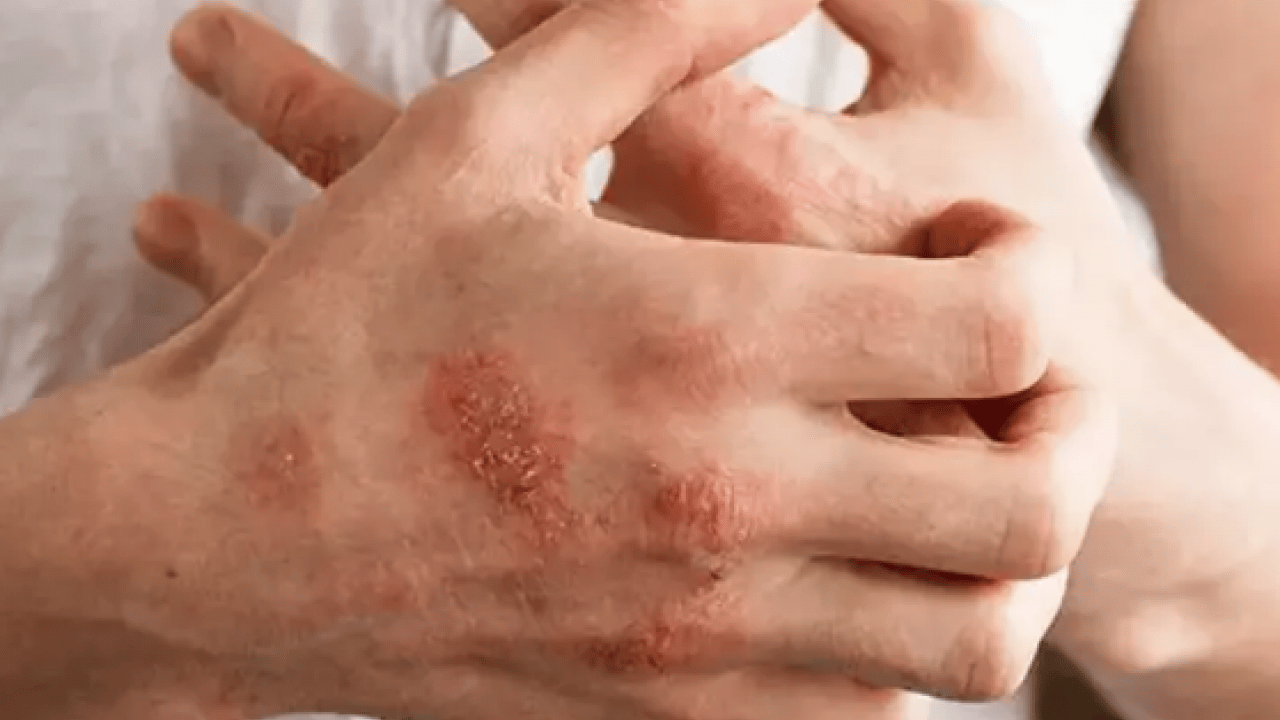 Foto - Cilt kuruyor! Kış aylarında egzama ile savaşmanın en etkili 7 yolu...