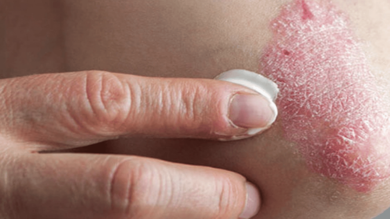 Foto - Cilt kuruyor! Kış aylarında egzama ile savaşmanın en etkili 7 yolu...