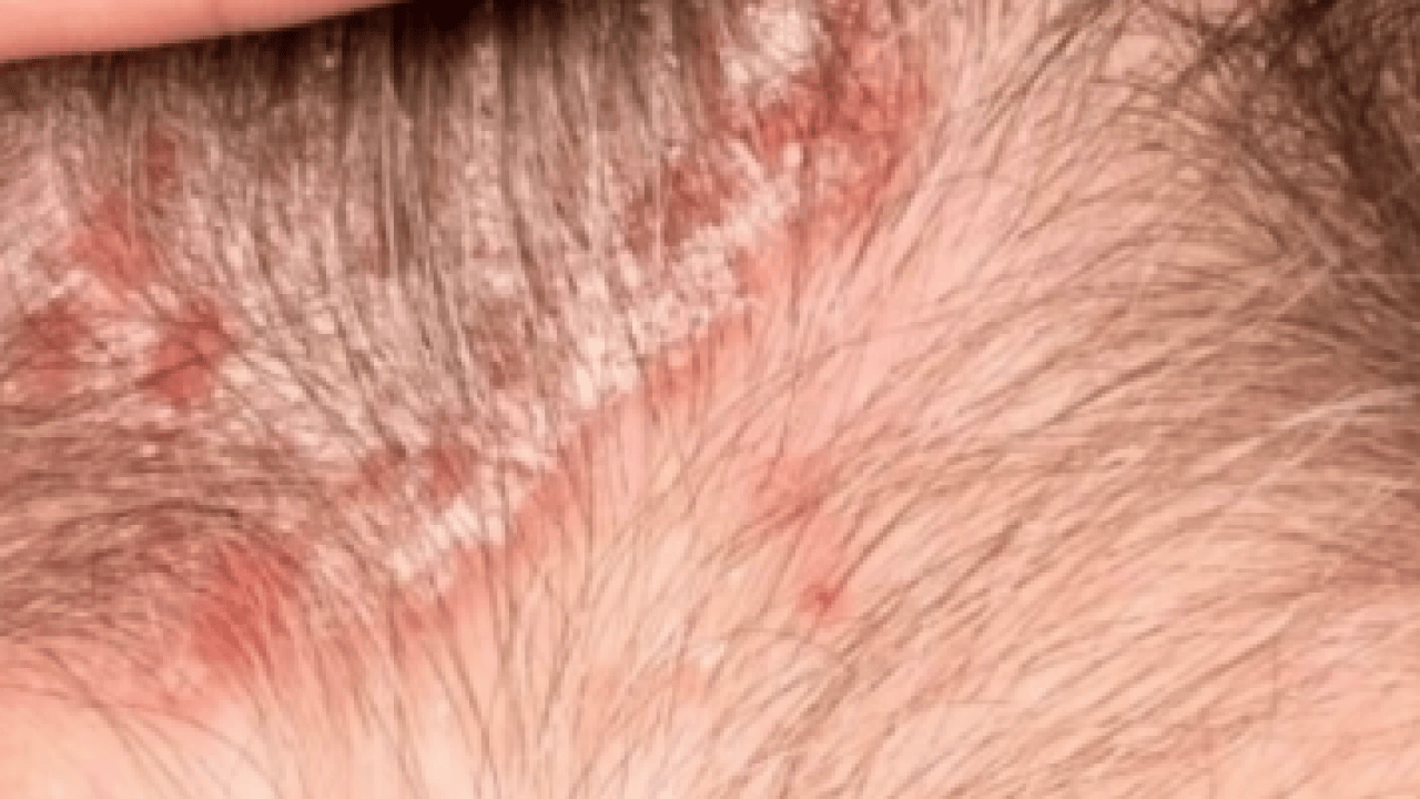 Foto - Cilt kuruyor! Kış aylarında egzama ile savaşmanın en etkili 7 yolu...