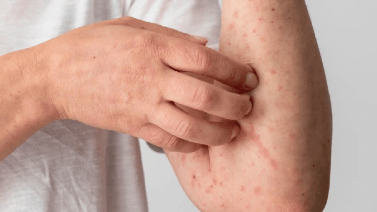 Foto - Cilt kuruyor! Kış aylarında egzama ile savaşmanın en etkili 7 yolu...