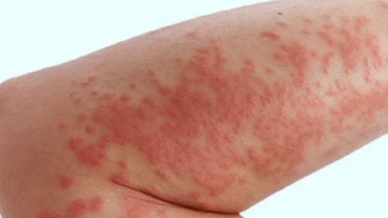 Foto - Cilt kuruyor! Kış aylarında egzama ile savaşmanın en etkili 7 yolu...