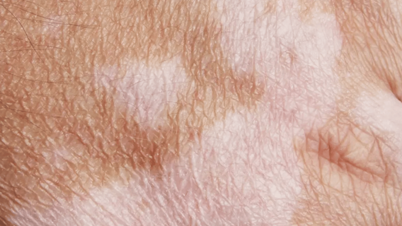 Foto - Cilt lekelerinin doğal açıcısı bu yöntem: Evde uygulayın kararmaları yok edin...