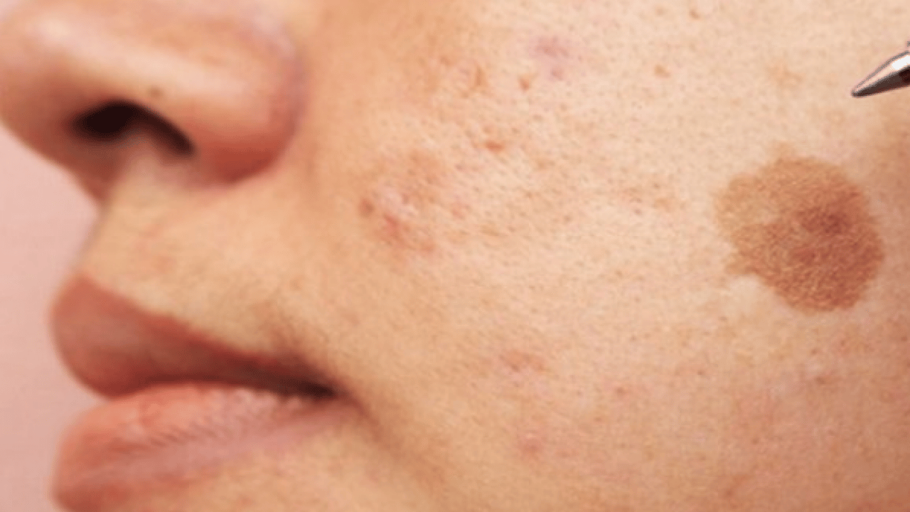 Foto - Cilt lekelerinin doğal açıcısı bu yöntem: Evde uygulayın kararmaları yok edin...