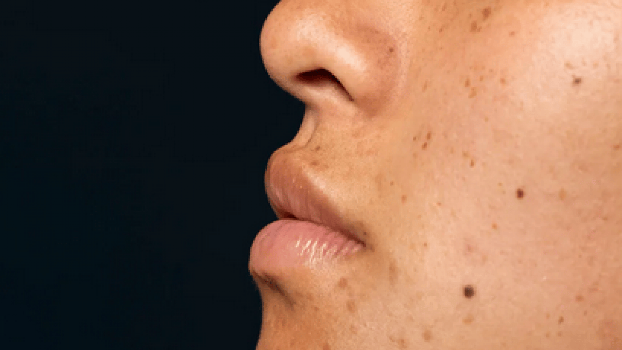 Foto - Cilt lekelerinin doğal açıcısı bu yöntem: Evde uygulayın kararmaları yok edin...