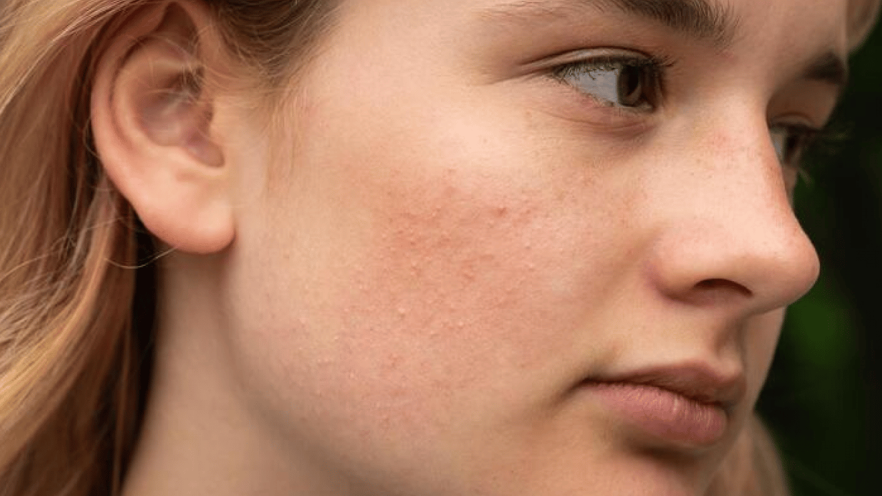 Foto - Cilt lekelerinin doğal açıcısı bu yöntem: Evde uygulayın kararmaları yok edin...