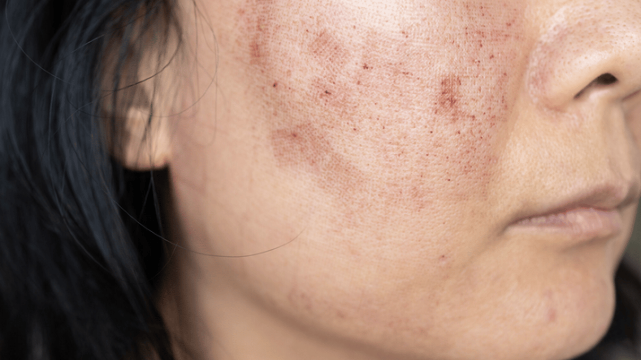 Foto - Cilt lekelerinin doğal açıcısı bu yöntem: Evde uygulayın kararmaları yok edin...