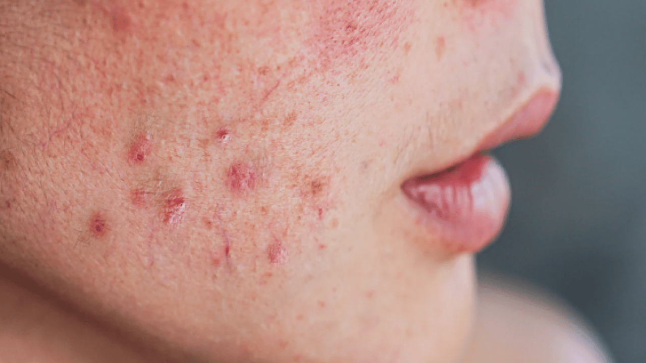 Foto - Cilt lekelerinin doğal açıcısı bu yöntem: Evde uygulayın kararmaları yok edin...