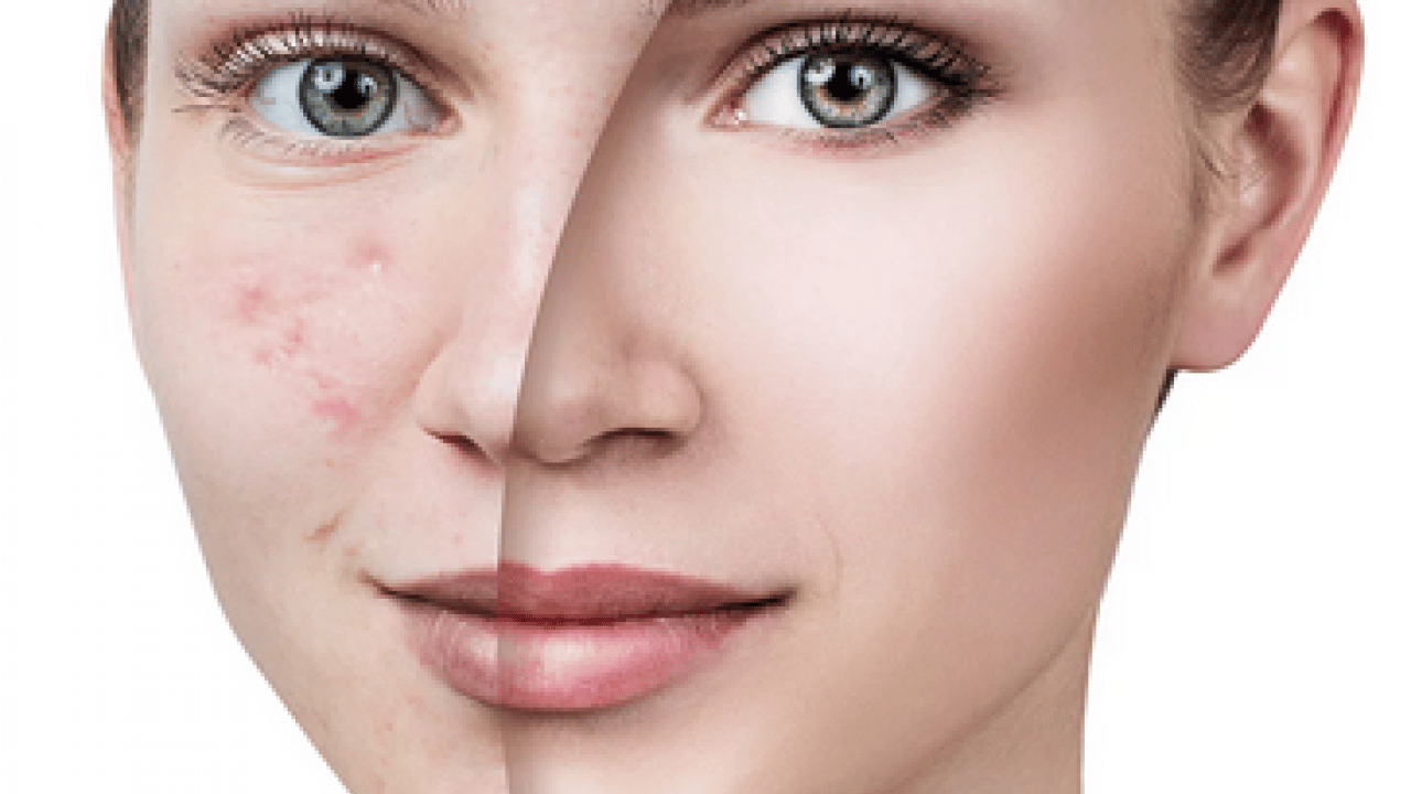 Foto - Cilt lekelerinin doğal açıcısı bu yöntem: Evde uygulayın kararmaları yok edin...