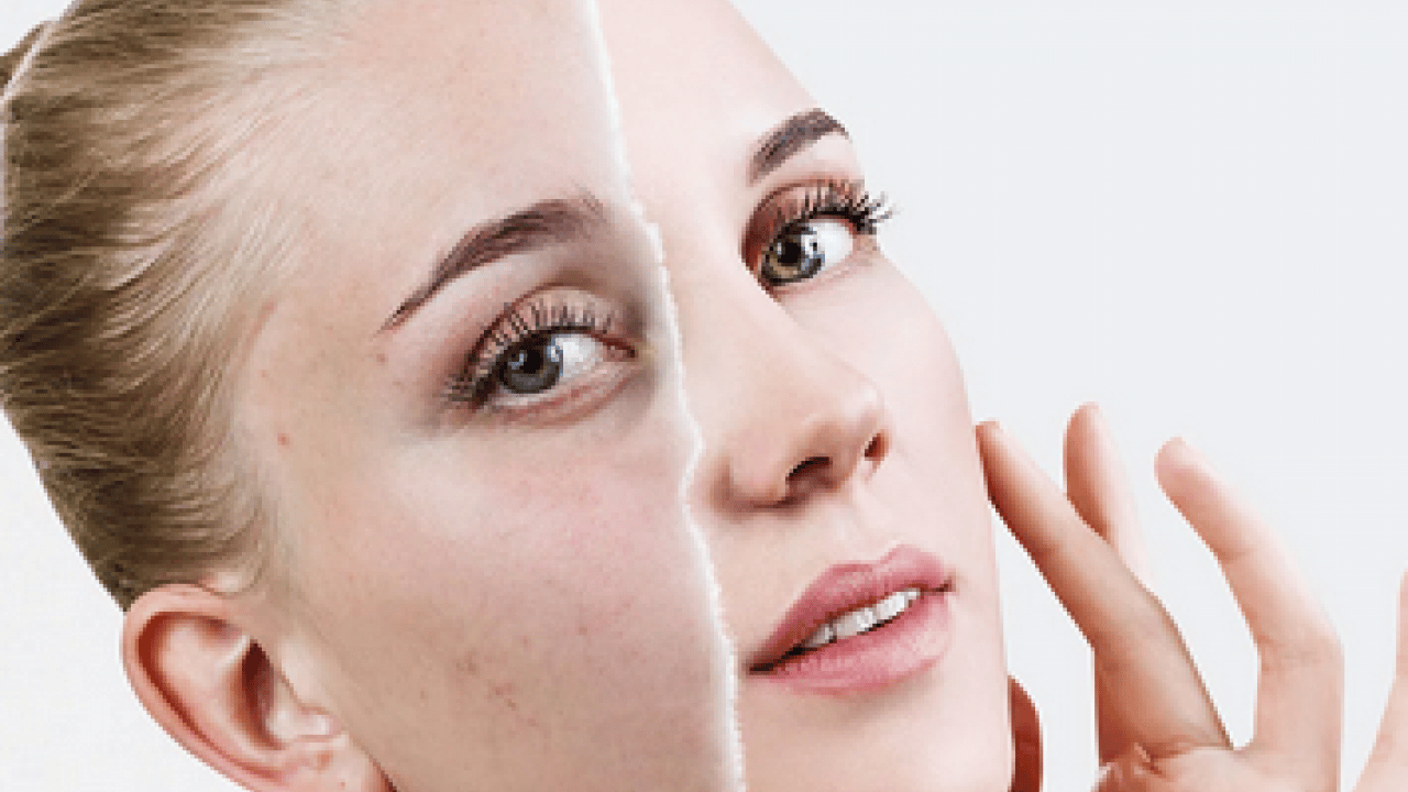Foto - Cilt lekelerinin doğal açıcısı bu yöntem: Evde uygulayın kararmaları yok edin...