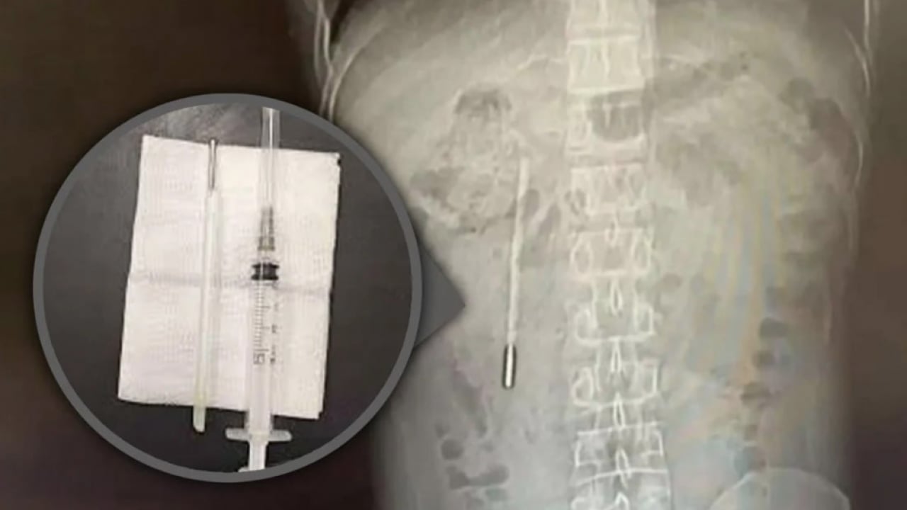 Foto - Çin'in gazetesi duyurdu: Doktorlar gördüğüne inanamadı! 20 yıl karnında termometre ile yaşadı