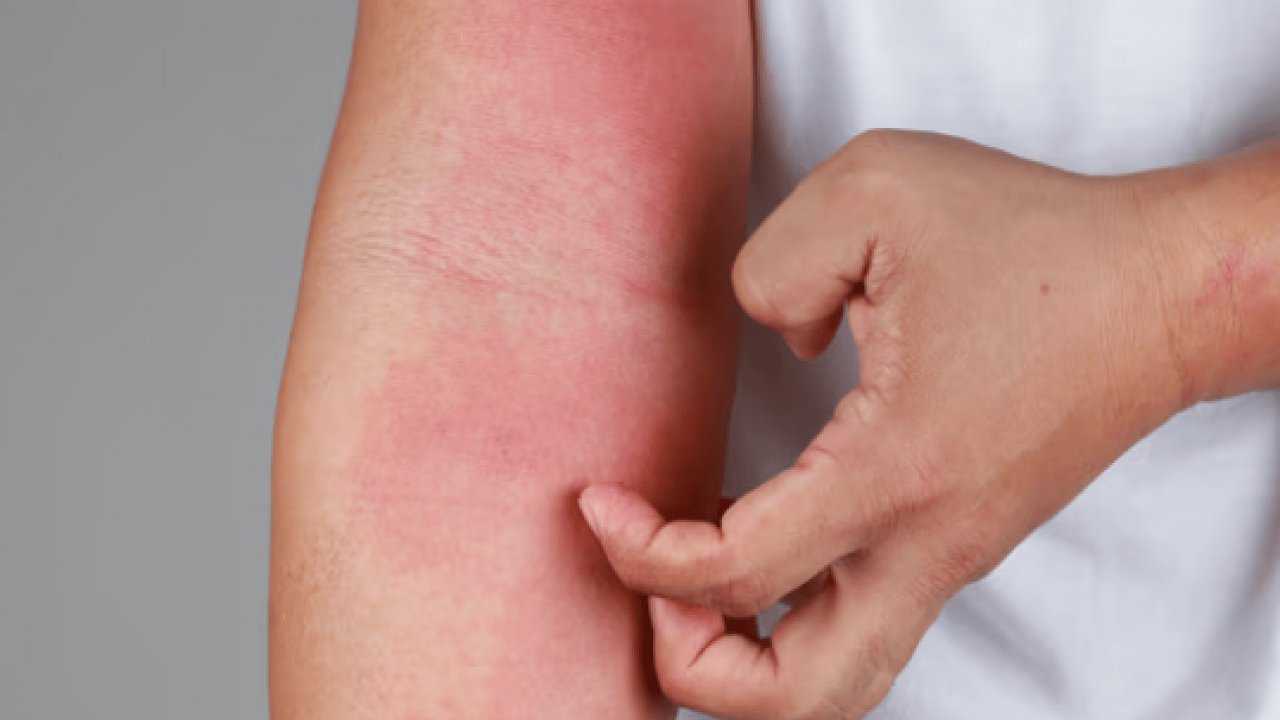 Foto - Uzmanından uyarı geldi: Dikkat edilmezse alerjiye çevirebilir!