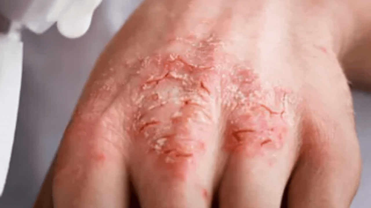 Foto - Uzmanından uyarı geldi: Dikkat edilmezse alerjiye çevirebilir!