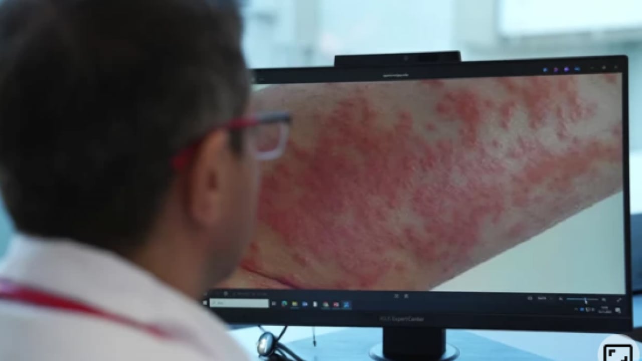 Foto - Uzmanından uyarı geldi: Dikkat edilmezse alerjiye çevirebilir!