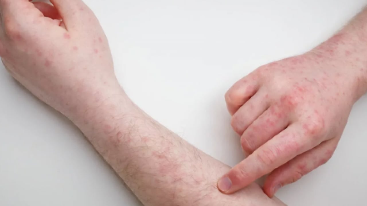 Foto - Uzmanından uyarı geldi: Dikkat edilmezse alerjiye çevirebilir!