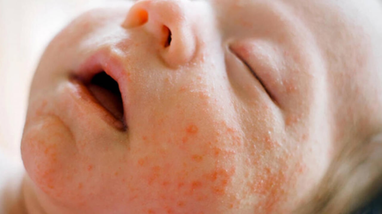 Foto - Uzmanından uyarı geldi: Dikkat edilmezse alerjiye çevirebilir!