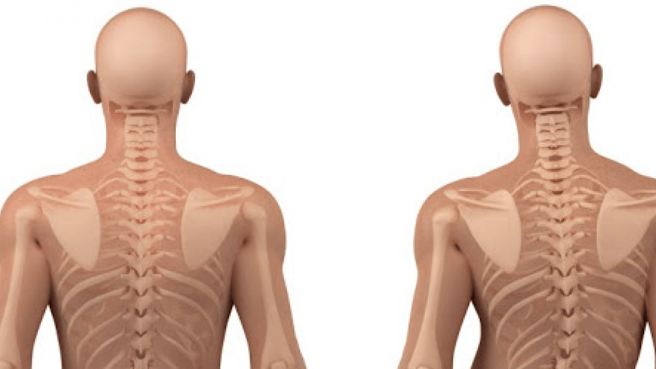 Foto - Çok büyük hastalıklara sebebiyet verebilir! Skolyoz uyarısına kulak verin...
