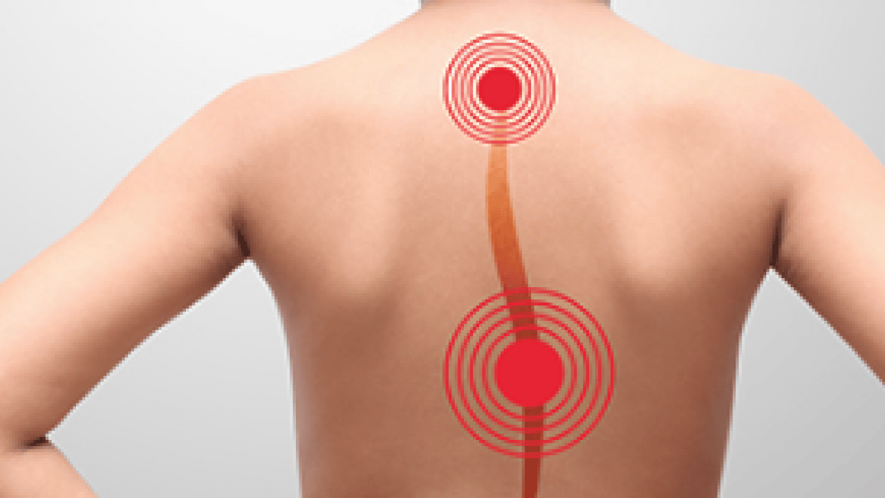 Foto - Çok büyük hastalıklara sebebiyet verebilir! Skolyoz uyarısına kulak verin...