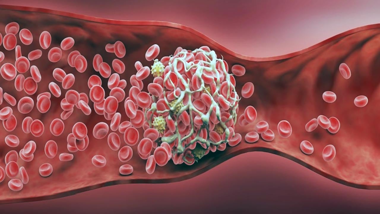 Foto - Covid 19 aşıları sonrası kan pıhtılaşması! Gizem sonunda çözüldü